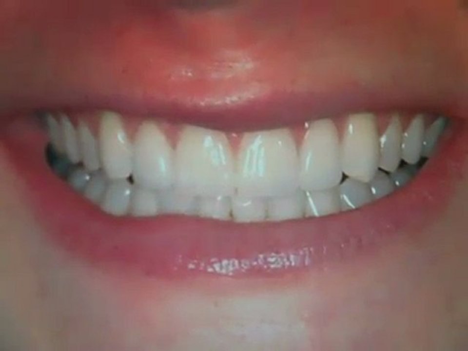 Front teeth gaps fixed - Veneers Austin, Tx- Lakew