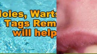 mole removal at home - female genital warts - genital warts in women
