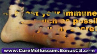 genital molluscum contagiosum - molluscum contagiosum treatment