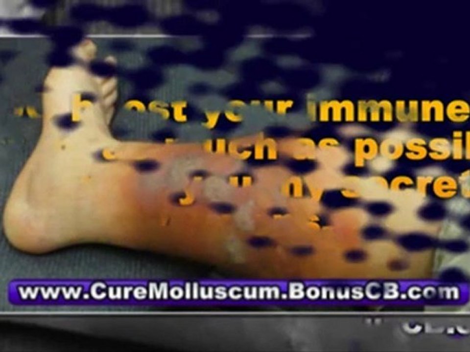 genital molluscum contagiosum - molluscum contagiosum treatment