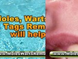 remove skin tags yourself - genital wart treatment - wart removal home remedies