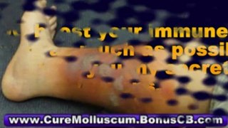 treatment for molluscum contagiosum - molluscum contagiosum treatment at home