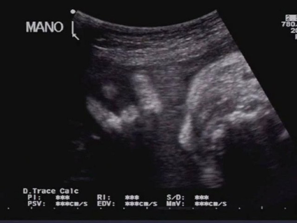 Acondroplasia