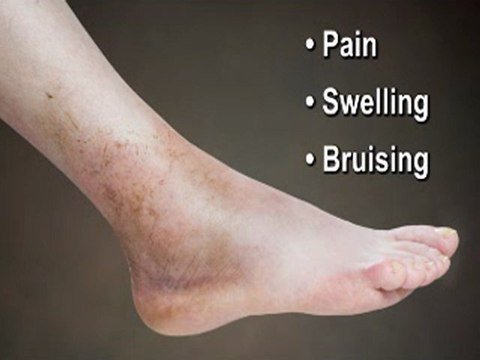 Ankle Sprains - Annapolis and Stevensville, MD Podiatrist
