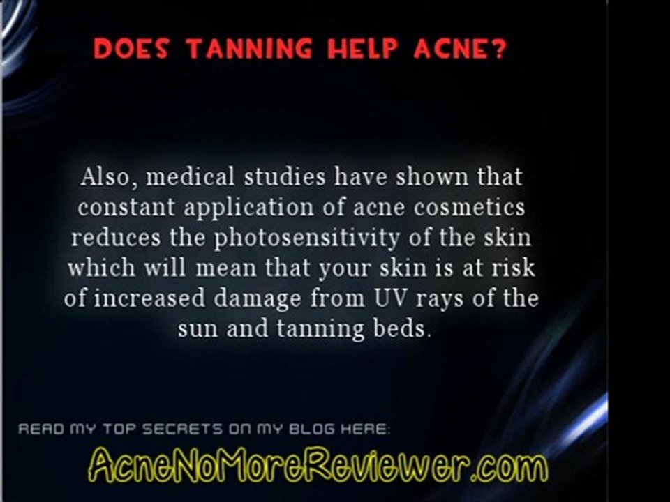 Does Tanning Help Acne