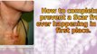 how to remove scars - how to get rid of acne scars fast - best scar treatment