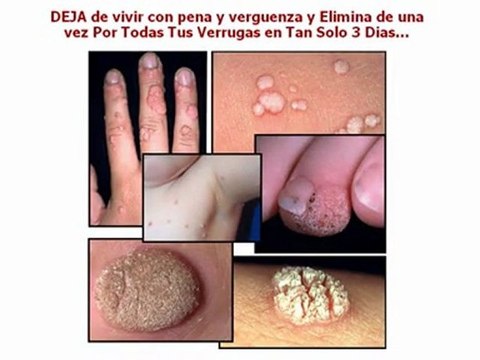 verruga plantar tratamiento - tratamiento para verrugas - como curar las verrugas