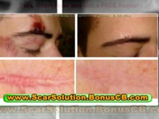 Download Video: treatments for acne scars - natural acne scar removal - how to remove pimple scars