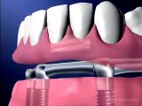 Implant supported Dentures Dentist-Fairless Hills, PA
