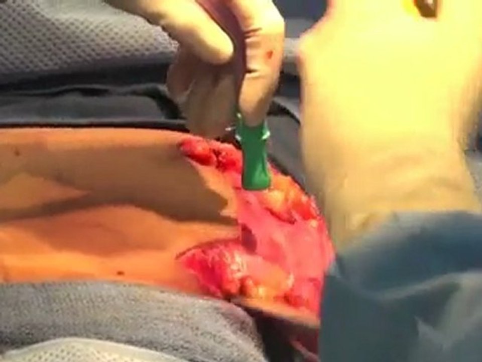 breast lift with breast implants, live plastic surgery video