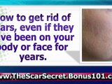 how to remove pimple scars - mole removal scar - breast reduction scars
