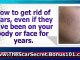 how to get rid of scars on legs - get rid of acne scars fast - home remedies for scars
