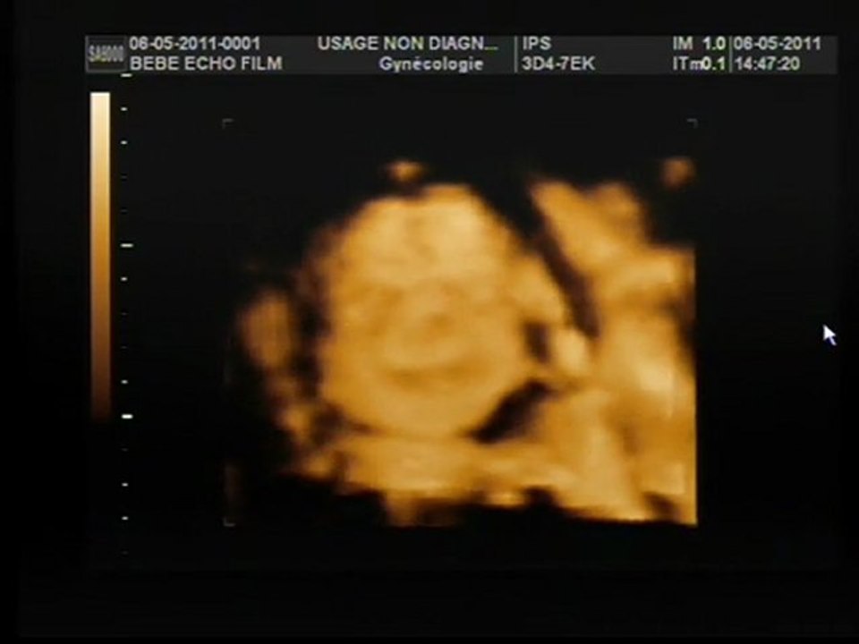 Clara, la vie en 3D, echo 3d/4d 25 SA+3