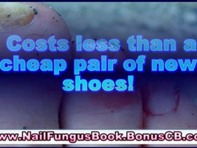 fingernail fungus treatment – toenail fungus home treatment