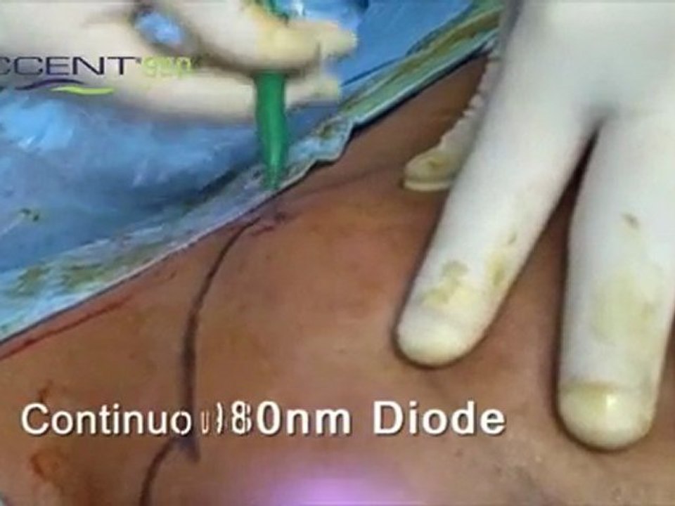 Laser Lipolysis, Accent 980