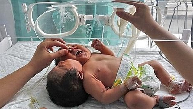 Une fillette née avec deux têtes.