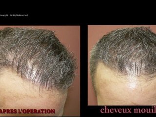 FUT_1871_Ufs_By_MEDIKEMOS_HAIR_TRANSPLANTATION_FR