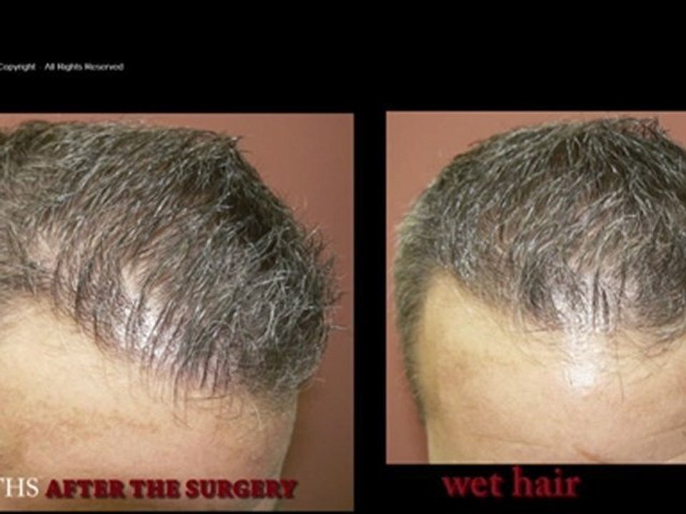 FUT_1871_Ufs_By_MEDIKEMOS_HAIR_TRANSPLANTATION_EN