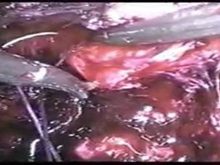 Mete Kilciler - LRP Interreptud Anastamoz Video