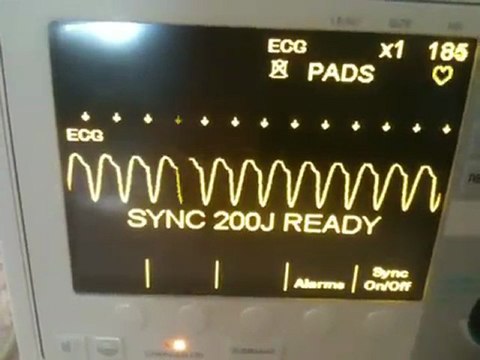 Ventricular Tachycardia cardioverted to Normal Sinus Rhythm per 2010 ACLS Guidelines