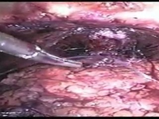 Mete Kilciler - LRP Interreptud Anastamoz Video 4