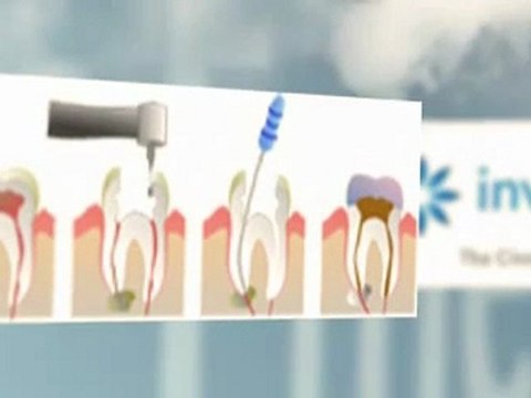 Milton Dental Cleanings