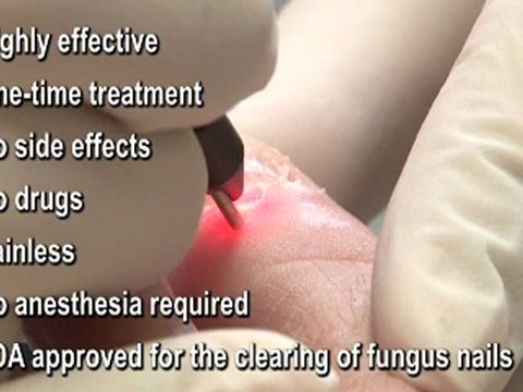 Laser - Fungal Toenails - Podiatrist in Hudson Valley, Ulster, Orange and Dutchess County, NY