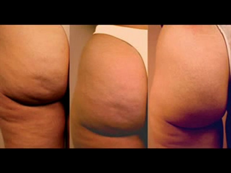 Como Eliminar Celulitis