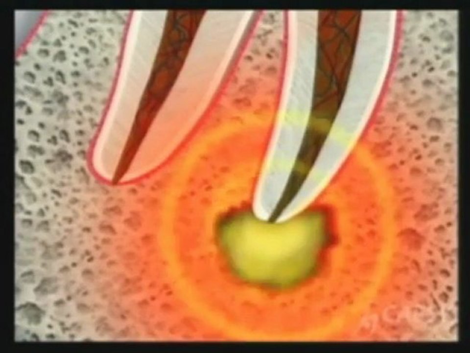 What is Tooth Abscess? by Kamran Sahabi Dentist Glendale, CA