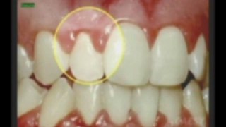 What is Periodontal Disease? by Kamran Sahabi Dentist Glendale, CA