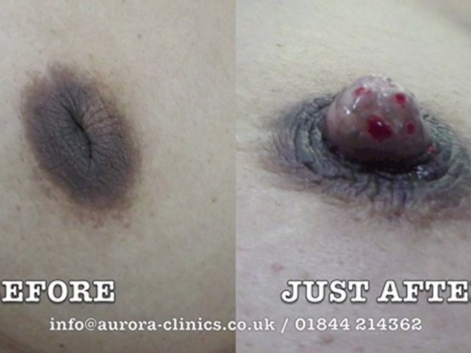 Inverted Nipples Before and After Correction photos