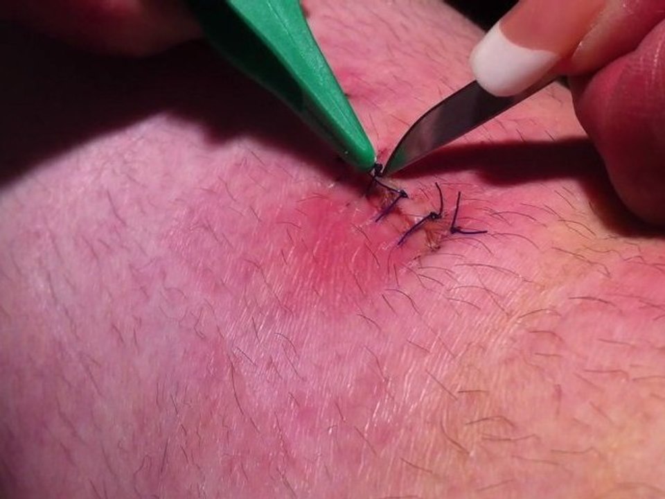 J+16 ablation des fils