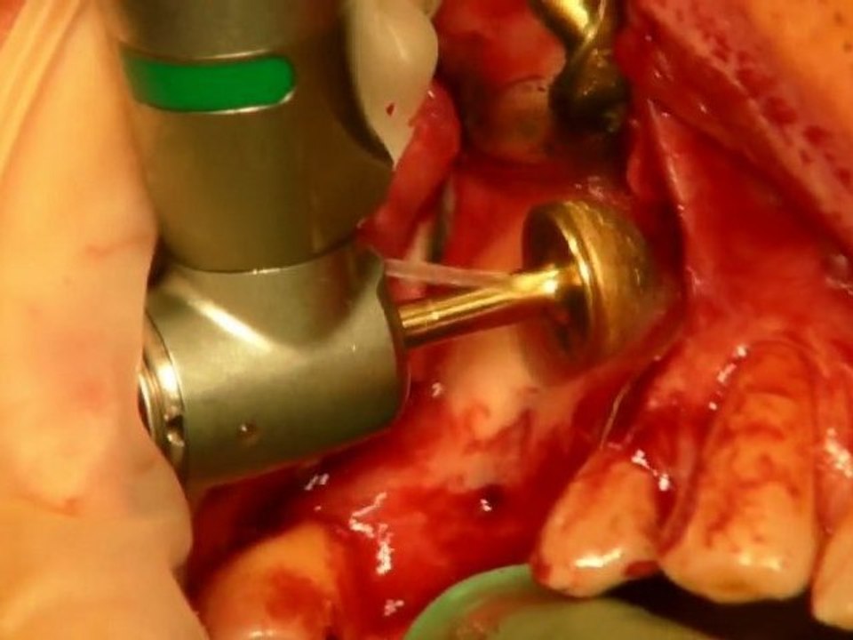 sinus lift Dask