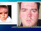 chickenpox in adults - chicken pox treatment - adult chicken pox