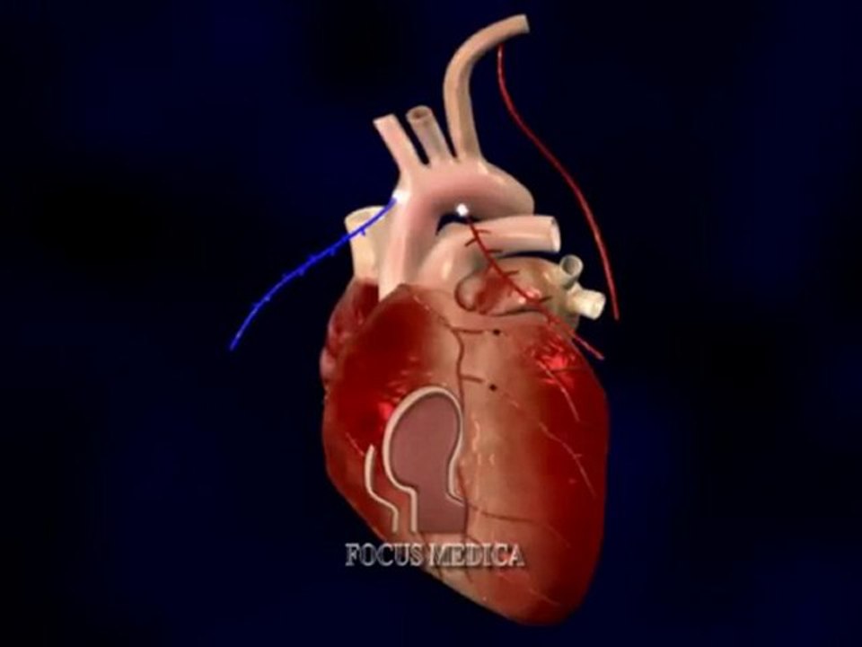 Coronary Artery Bypass Graft
