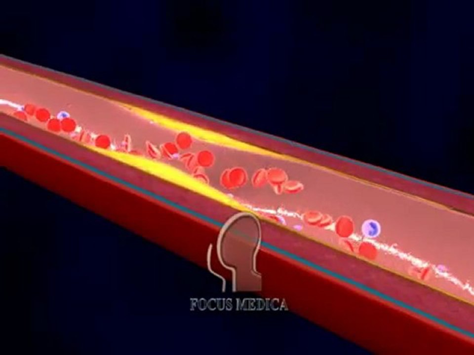 Percutaneous Transluminal Coronary Angioplasty