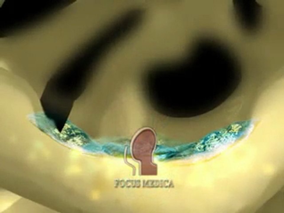 Postmenopausal Osteoporosis