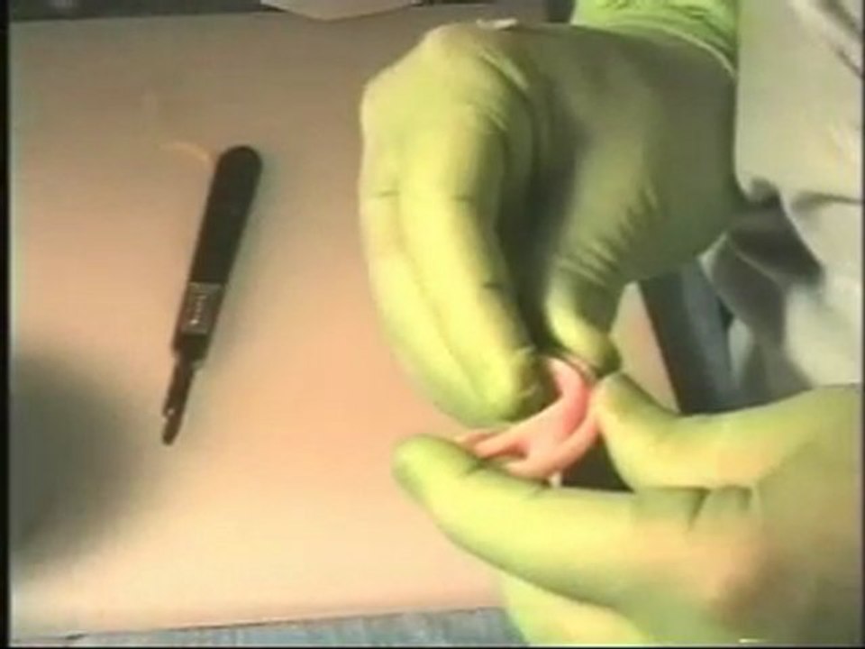 Microtia Ear Reconstruction using MEDPOR Ear Implant - John Reinisch, MD