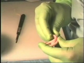 Microtia Ear Reconstruction using MEDPOR Ear Implant - John Reinisch, MD