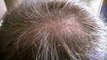 Order Propecia Finasteride Hair Loss
