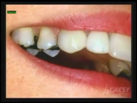 The Deficient's of Silver Dental Fillings by Kamran Sahabi Dentist Glendale, CA