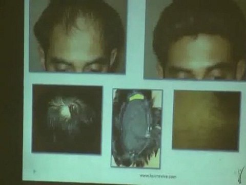 Current Trends in Managing Hair Loss Part 4.wmv