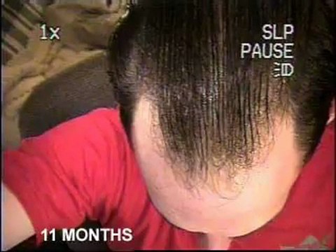 Buy Finasteride online, cheap Finpecia, free prescription.