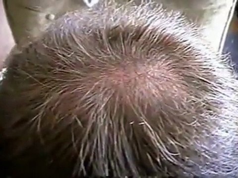 Finasteride online, cheap Finpecia, free prescription