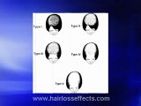 Causes Of Thinning Hair Or Hair Loss