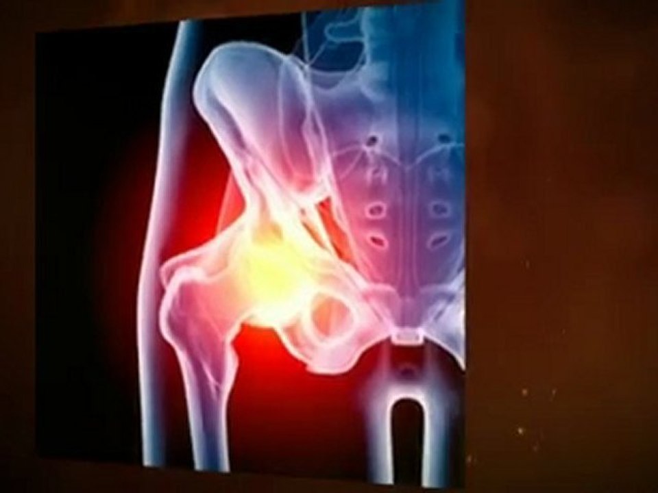 Depuy Hip Recall