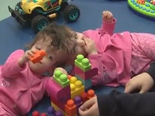 Conjoined Twins Sharing a Brain