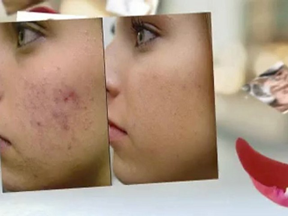 acne laser skin treatment NYC