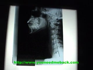 Denver Chiropractor reading neck x rays from whiplash