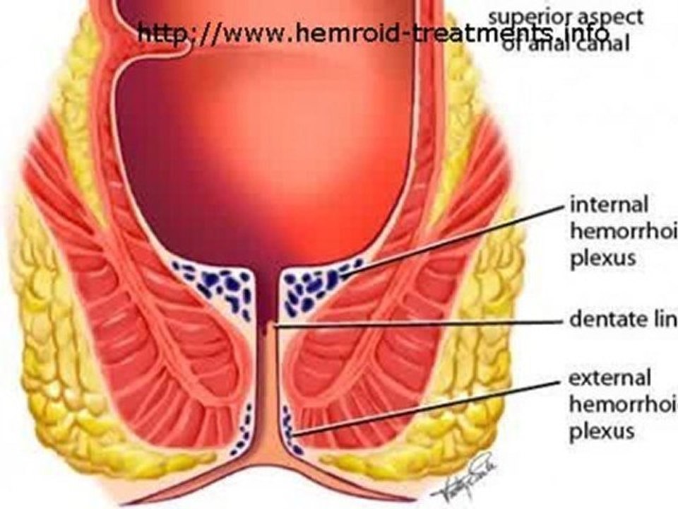Get Rid Of The Itch And Pain Of Hemorrhoids